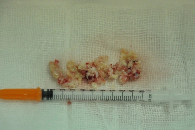 Silicon hóa 'đá' sau 30 năm bơm vào mũi ảnh 1