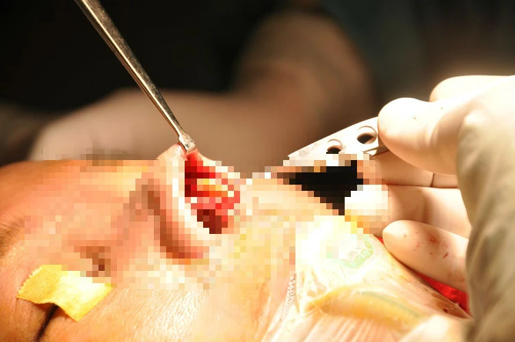 Silicon hóa 'đá' sau 30 năm bơm vào mũi ảnh 3