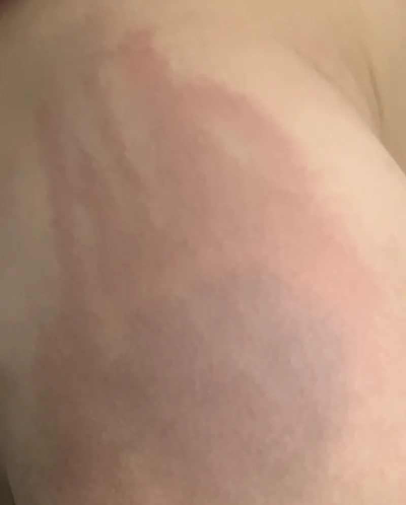 trẻ bị nhiều vết đỏ ở mông