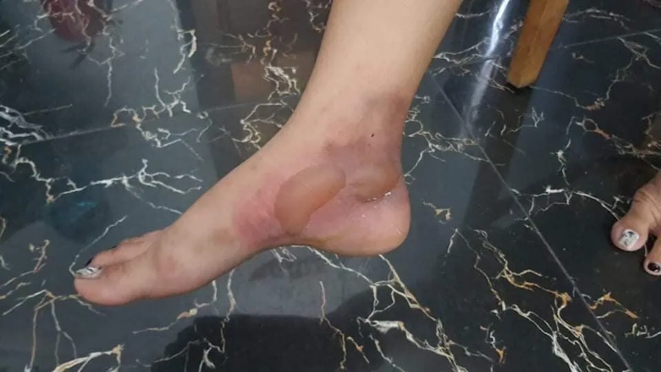 Vụ việc làm chị Tr bị bỏng ở chân.