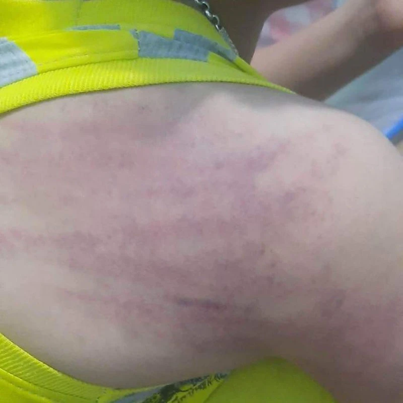 Vai cháu TTA bị bầm tím sau khi bị bà V đánh. Ảnh gia đình cháu A cung cấp.