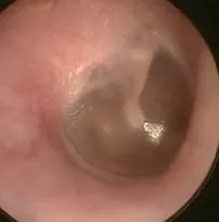 Viêm tai ngoài ảnh 2 Viêm tai ngoài ảnh 2