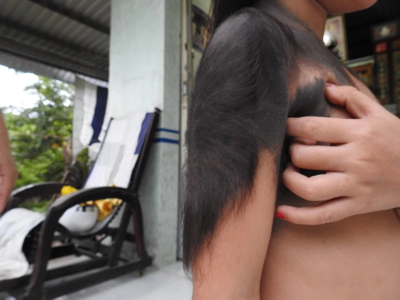 Kỳ lạ bé gái 5 tuổi mọc lông đầy mình như người sói - ảnh 2