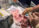 Bé gái tim ngoài lồng ngực sống sót thần kỳ