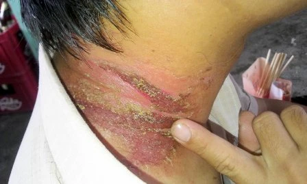 Sau vài ngày, vết cắn đã lở và&nbsp;lan ra rộng