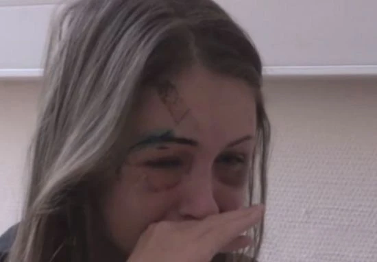 Siêu mẫu Nga biến dạng mặt vì bị người yêu đại gia đánh 2