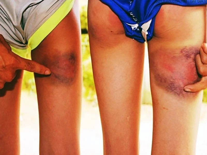 Kỷ luật cảnh cáo thầy giáo đánh 6 học sinh bầm tím ảnh 1