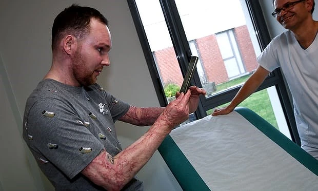 Hiến gần 1/2 lớp da trên cơ thể để cứu anh mình ảnh 2