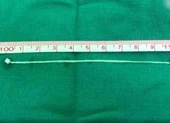 Kinh dị giun dài 10 cm sống trong não người đàn ông 30 năm 