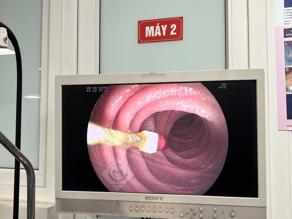 kim diệt tủy răng.jpg