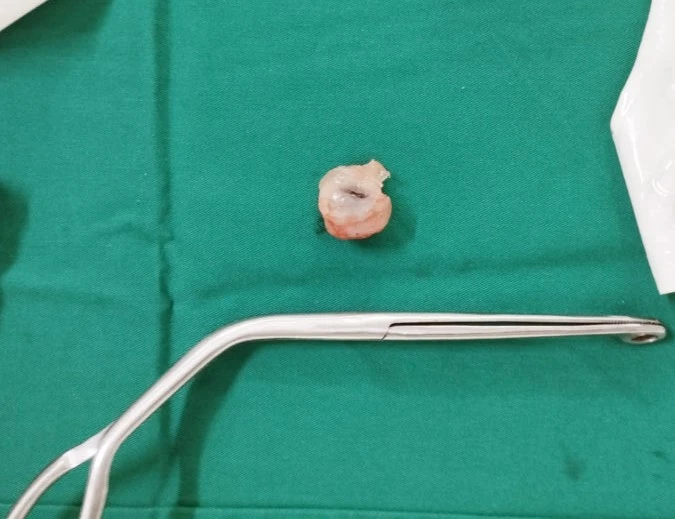 hóc quả nhãn.jpg