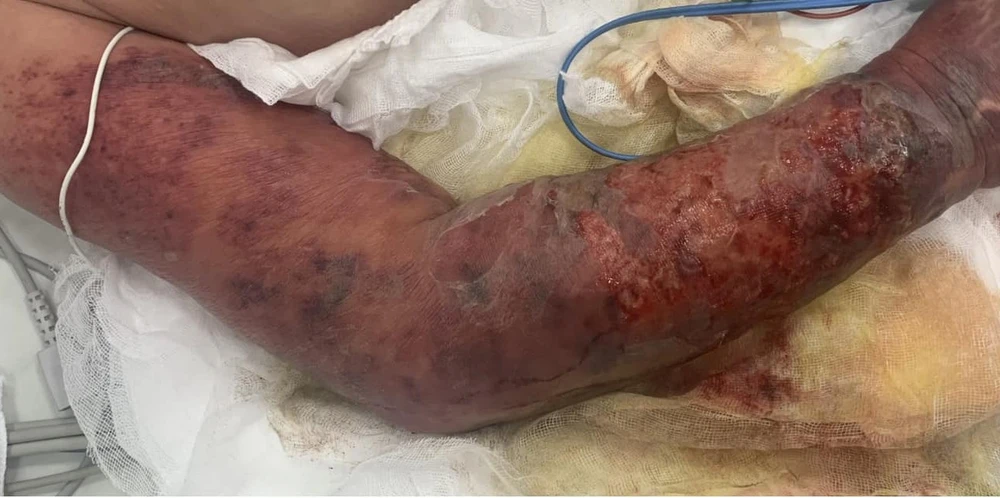 sốc nhiễm khuẩn.jpg