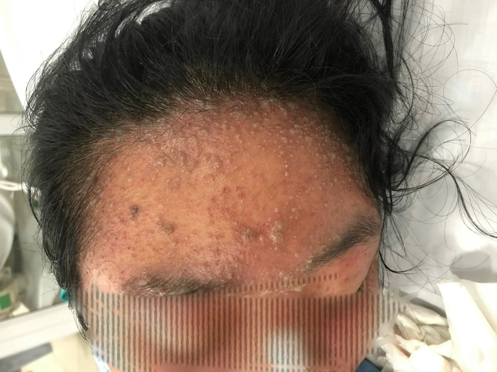 biến chứng thủy đậu.jpg