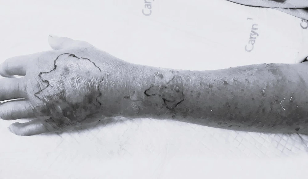 trẻ 3 tuổi cắn.jpg