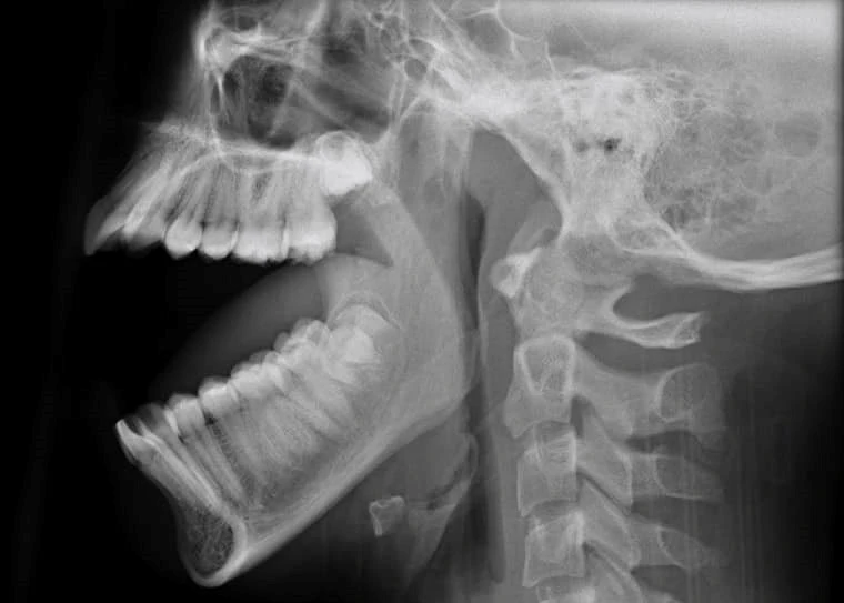 trật khớp hàm.jpg