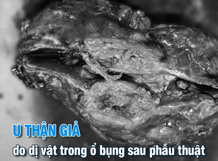 gạc nằm trong bụng