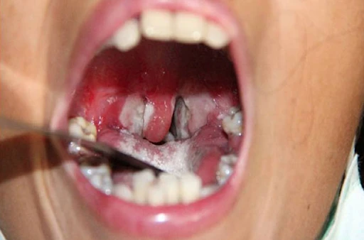 tử vong do bạch hầu.png