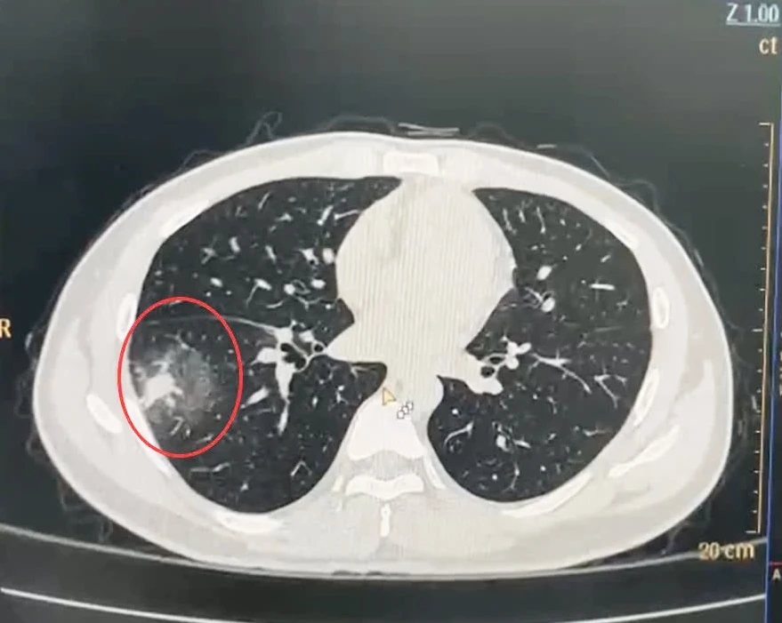 bệnh viêm phổi 0.jpg