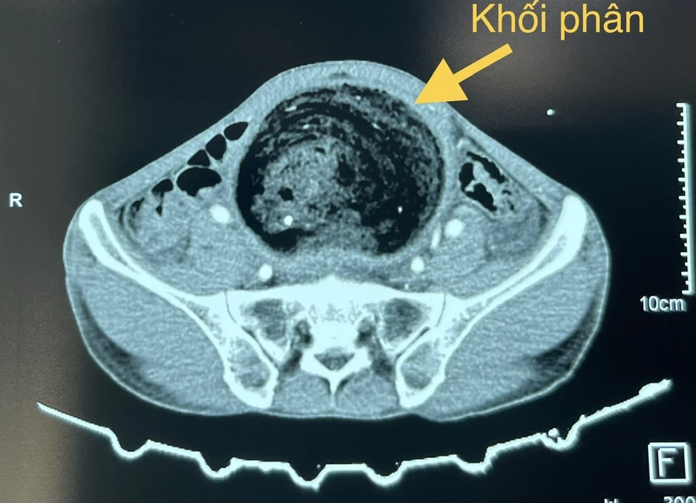 khối phân tích tụ trong 3 năm