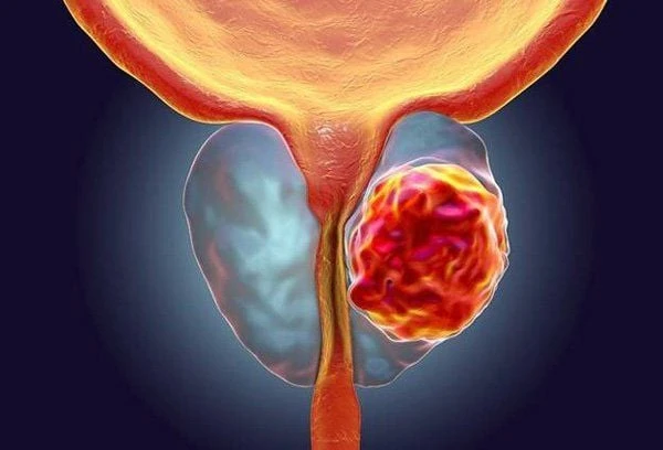 Ung thư tuyến tiền liệt