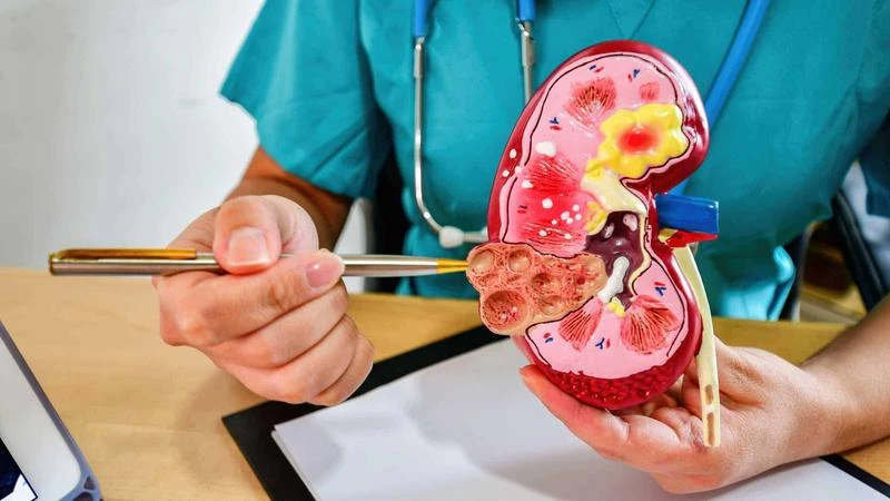bệnh sỏi thận