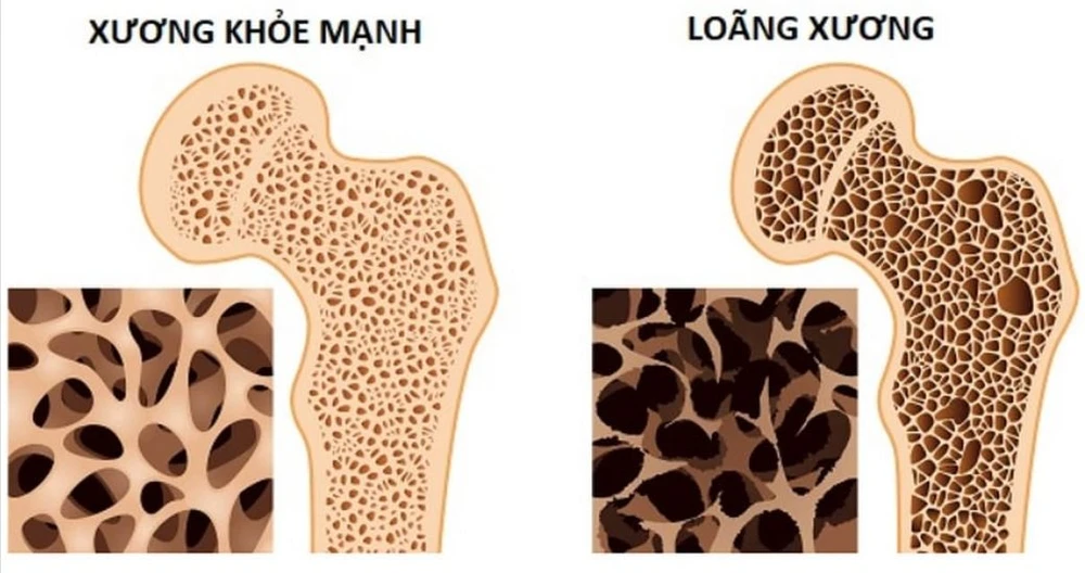 thiếu canxi 00.jpg