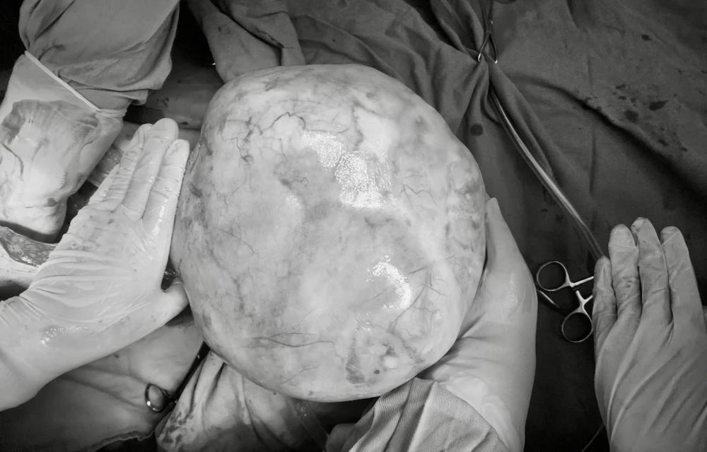 u buồng trứng 1.jpg