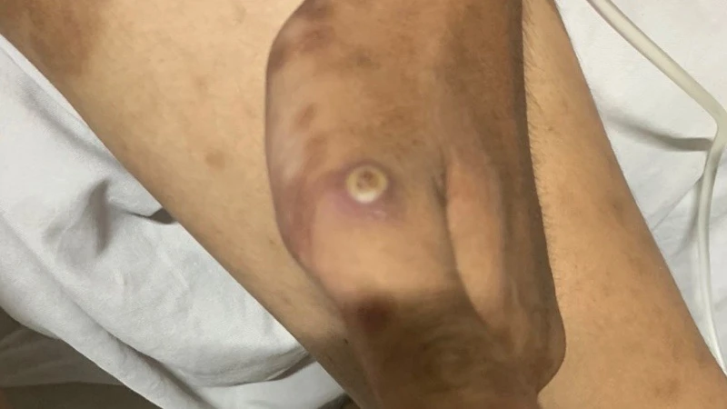 bệnh đậu mùa khỉ.jpeg