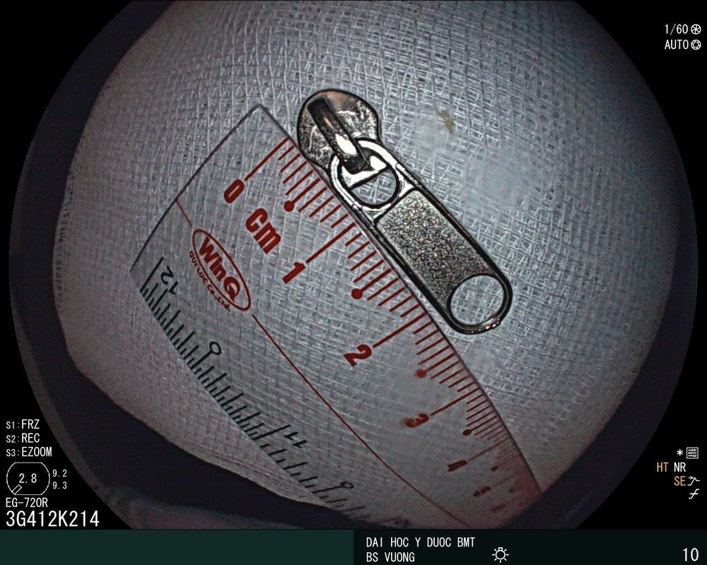 Khóa kéo bên trong dạ dày bé trai 6 tuổi