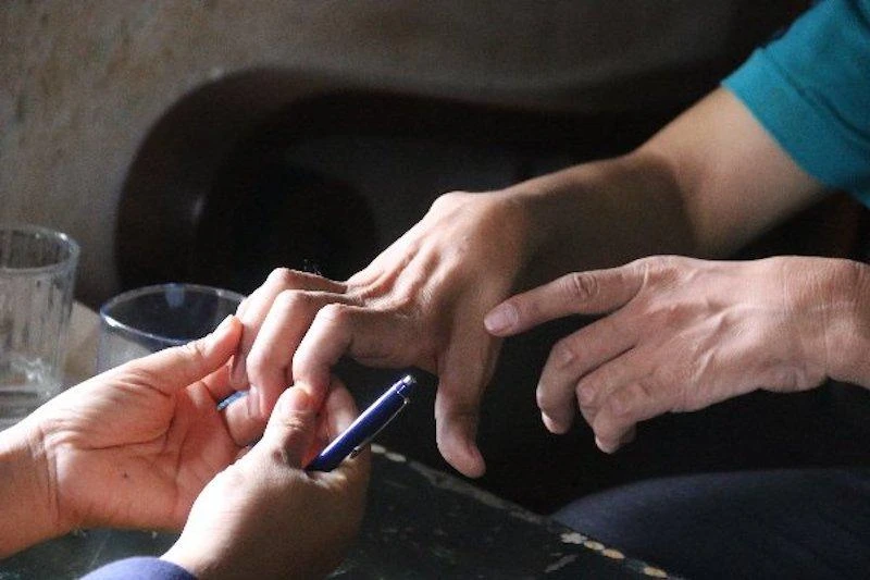 Bàn tay của anh Giáp không duỗi thẳng được như người bình thường.