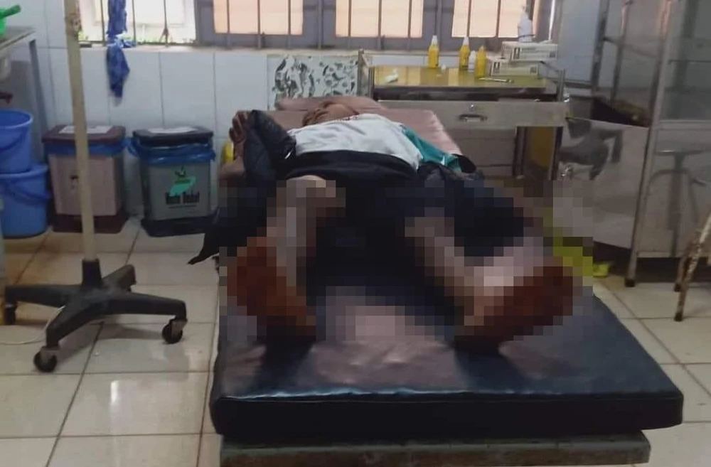 Y Ngách Niê bị bỏng cả 2 chân. Ảnh: VL