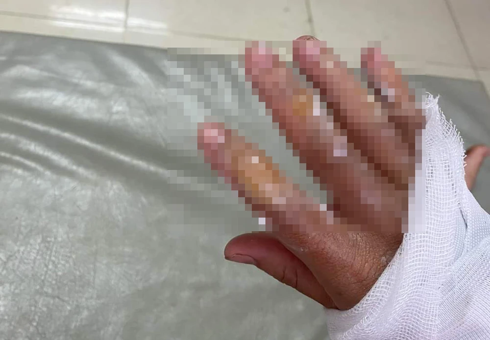 Một người bị bỏng ở tay. Ảnh: AX