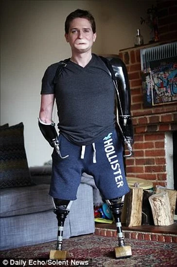 Sức mạnh của người đàn ông bị vi khuẩn ăn 4 chi ảnh 1