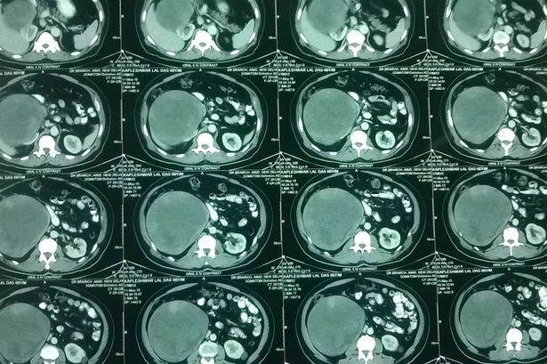 Đến viện khám ho, phát hiện u thận nặng 5 kg ảnh 2