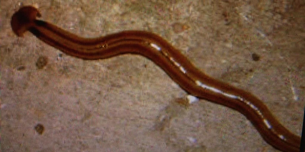 Rùng mình: 20 dạng vật lạ trong cơ thể người ảnh 19