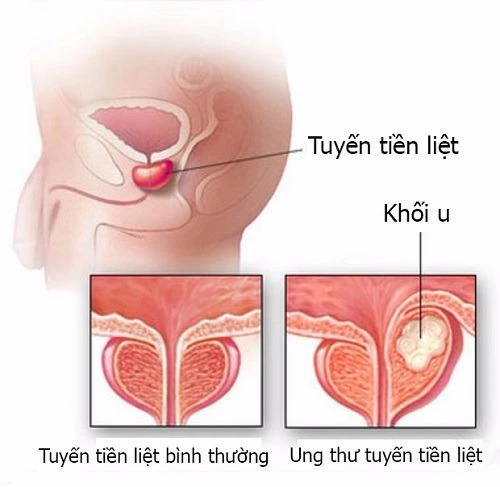 Ung thư tuyến tiền liệt rất nguy hiểm