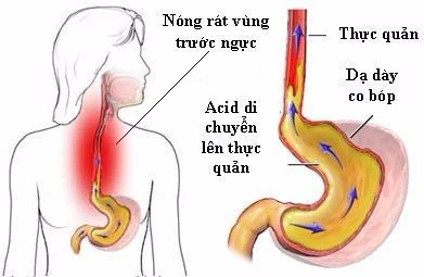 dấu hiệu của bệnh dạ dày