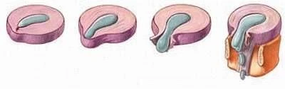 các giai đoạn tiến triển của thoát vị đĩa đệm
