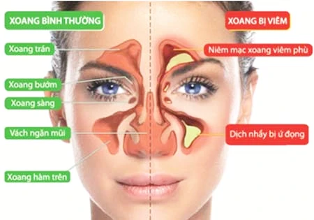xoang bình thường và xoang bị viêm