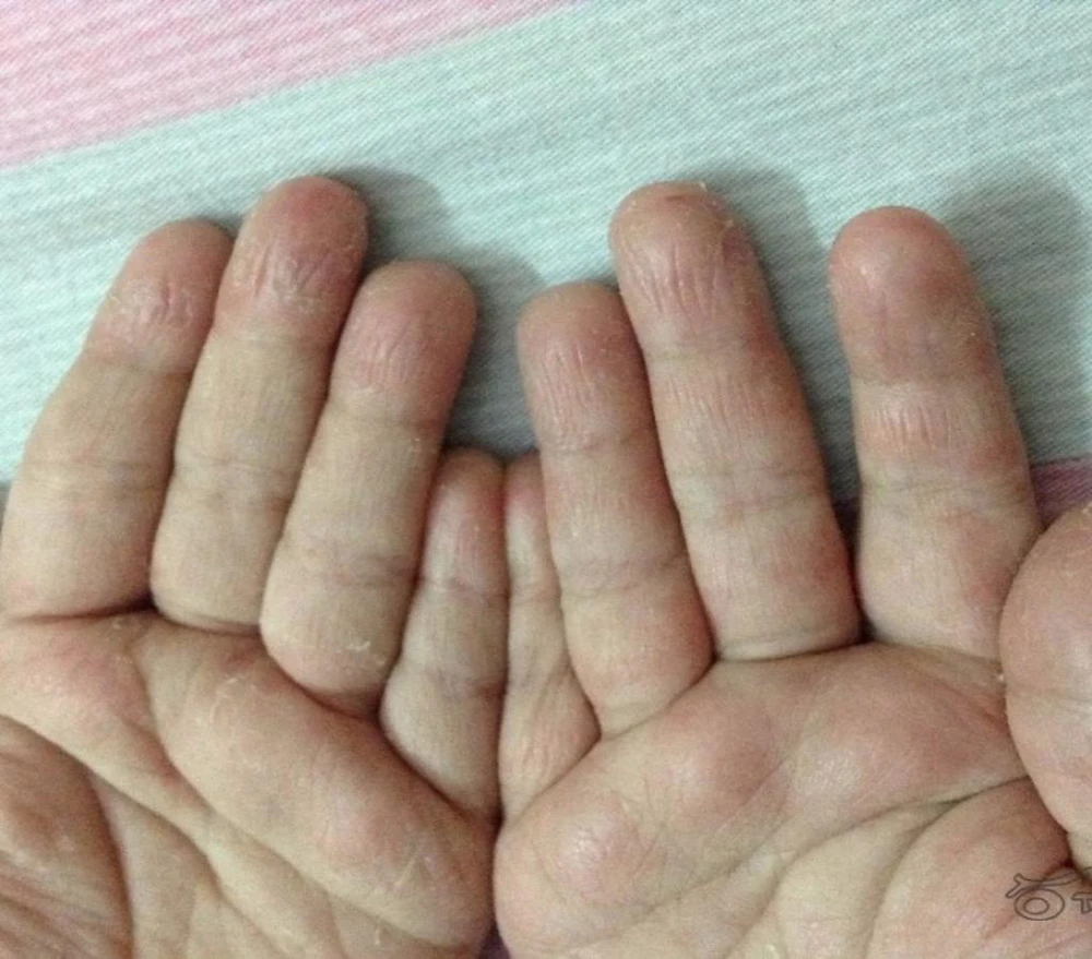 Tróc da bàn tay, bệnh gì? ảnh 1 tróc da tay