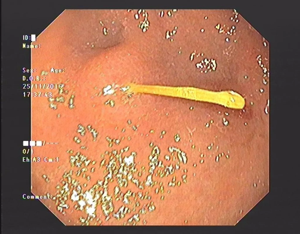 cây tăm tre trong dạ dày