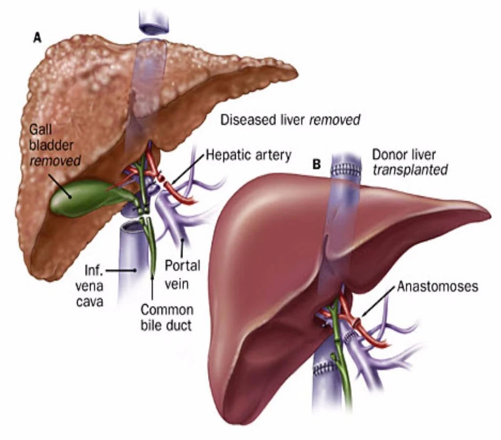 ung thư gan giai đoạn muộn