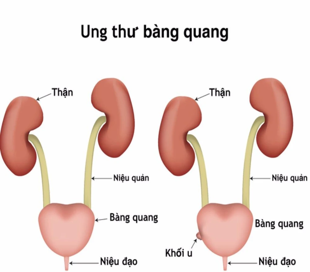 Ung thư bàng quang ảnh 1 ung thư bàng quang