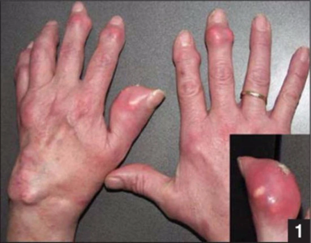 Người bệnh gút dùng thuốc cần đề phòng các yếu tố nguy cơ khiến bệnh nặng hơn.