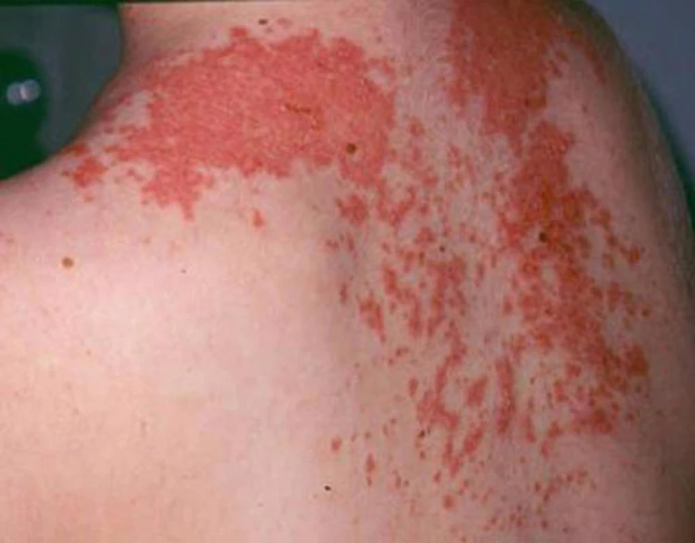 Tổn thương da trong bệnh giời leo.