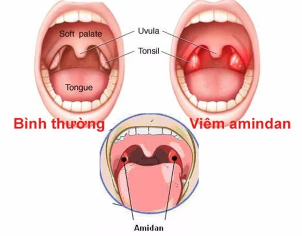 amidan bình thường và amidan bị viêm
