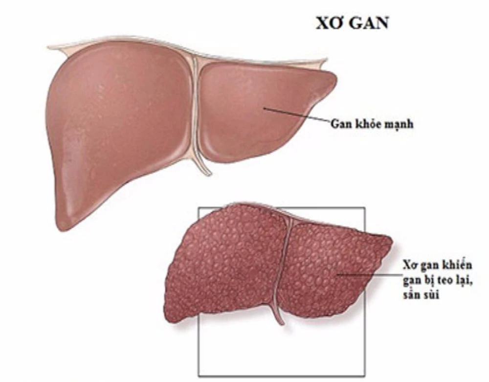 hôn mê gan xuất hiện giai đoạn cuối của bệnh xơ gan