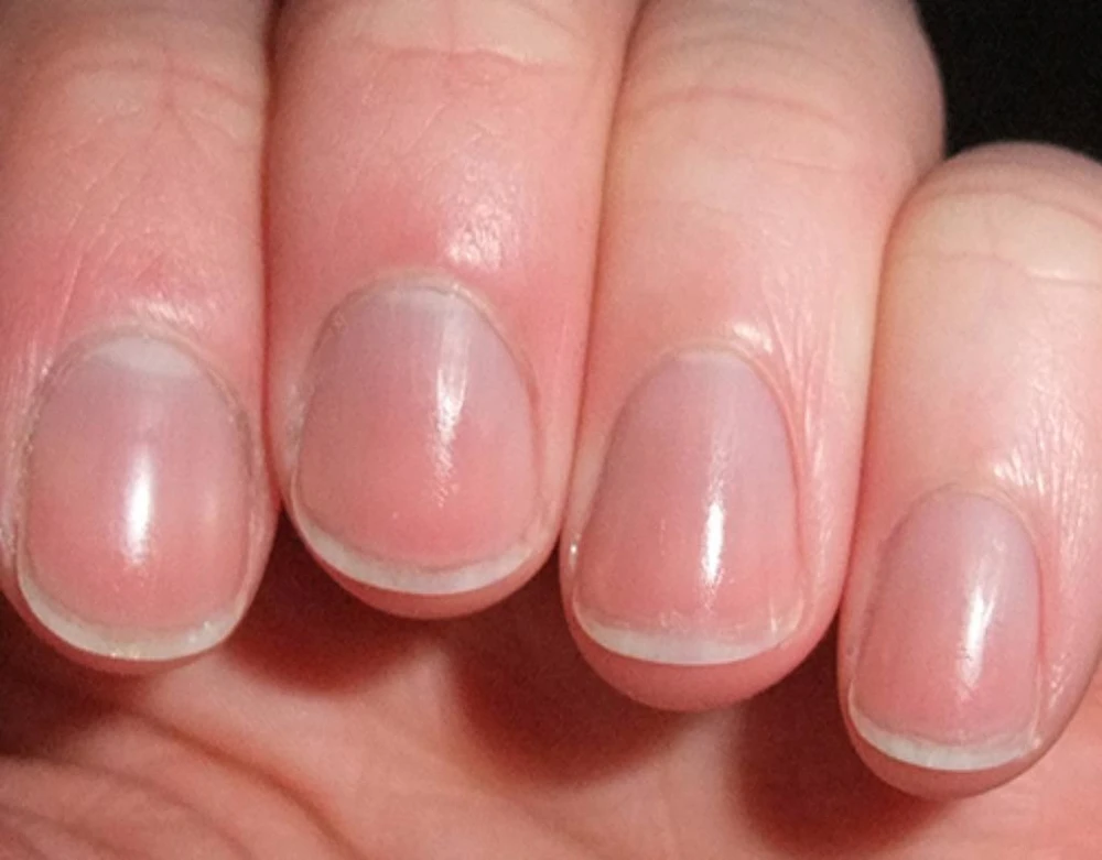 Nếu móng tay nửa trắng nửa nâu hoặc màu tối, nên sớm đi khám bác sĩ.