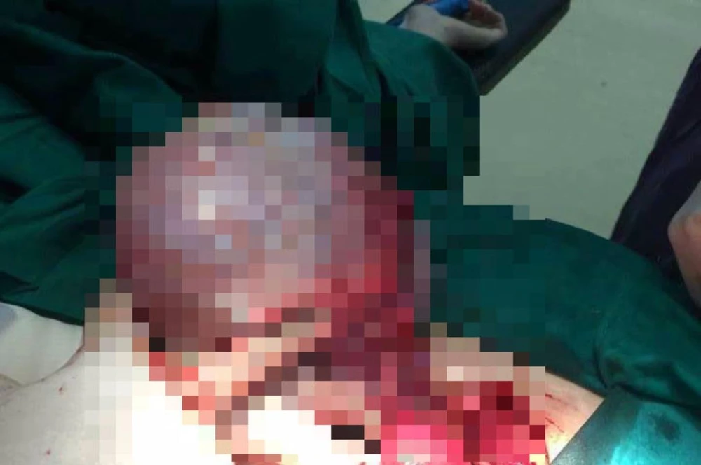 Khối u nhầy buồng trứng khủng nặng 1,8kg đã được các bác sĩ lấy ra khỏi bụng nữ bệnh nhân