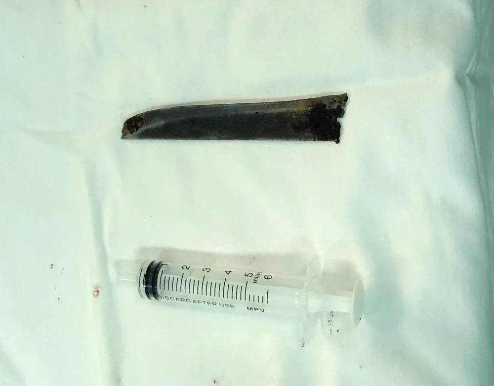 Lưỡi dao Thái Lan dài 12cm được lấy ra sau bốn năm nằm trong cơ thể anh L. 